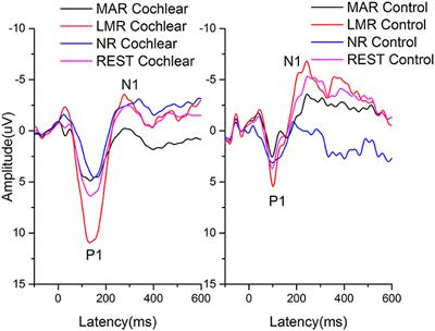 Effect of Different References on Auditory-Evoked Potentials in Children with Cochlear Implants